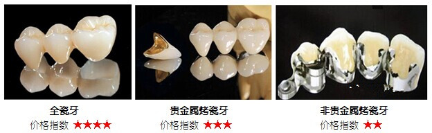 后面的大牙镶一颗烤瓷牙多少钱?