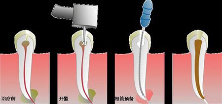 无锡滨湖区牙齿根管治疗多少钱